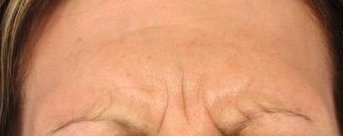 Glabella Before Botox