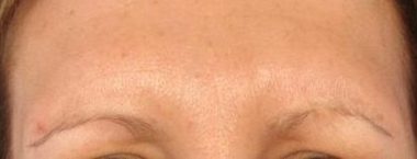 Glabella Lines 2 weeks after Botox