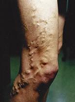 VARICOSE VEINS1 (1)