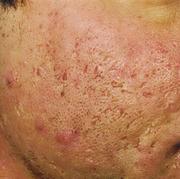 acne3 (1)