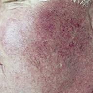 Facial veins caused by excessive sun exposure