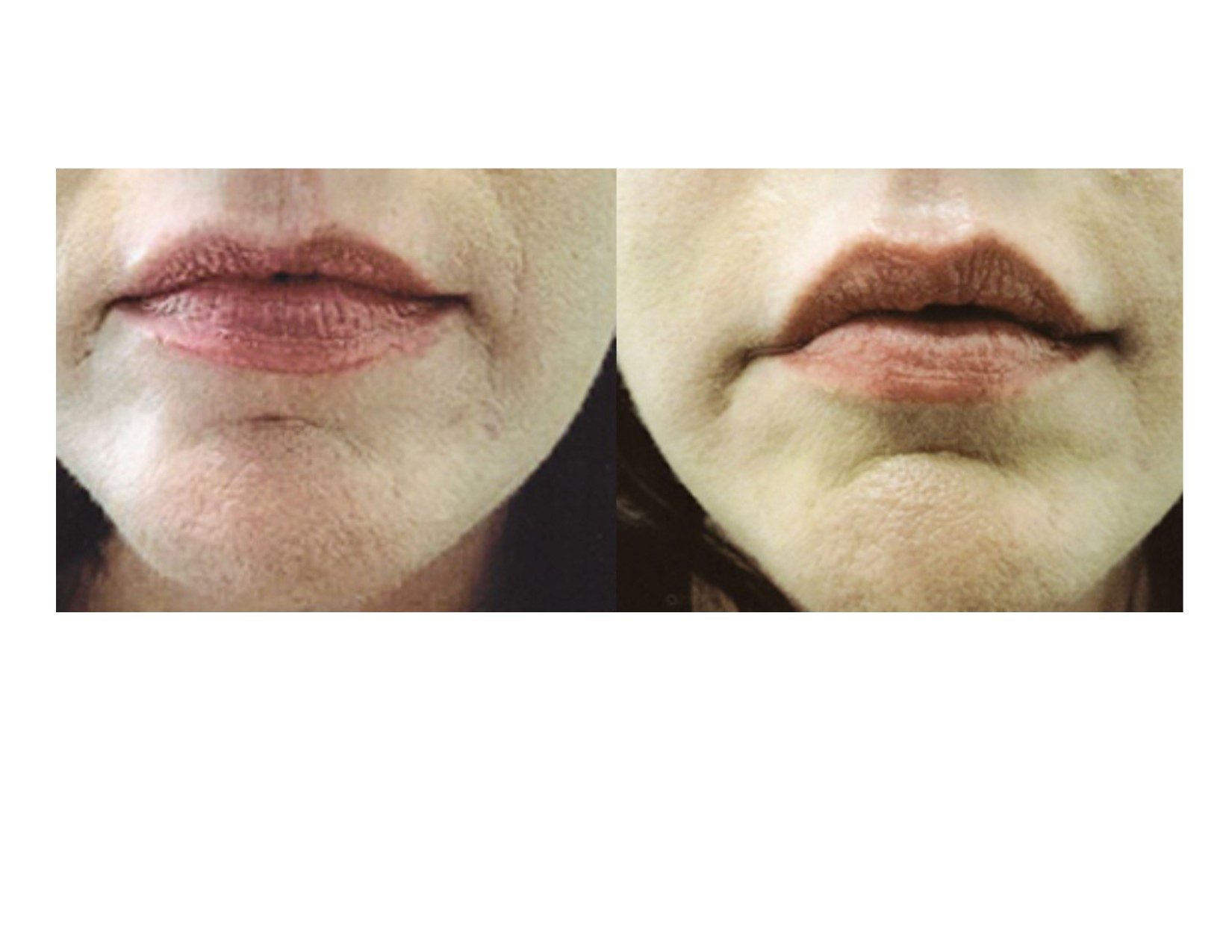 lip filler by Robert T. Motazedi, MD