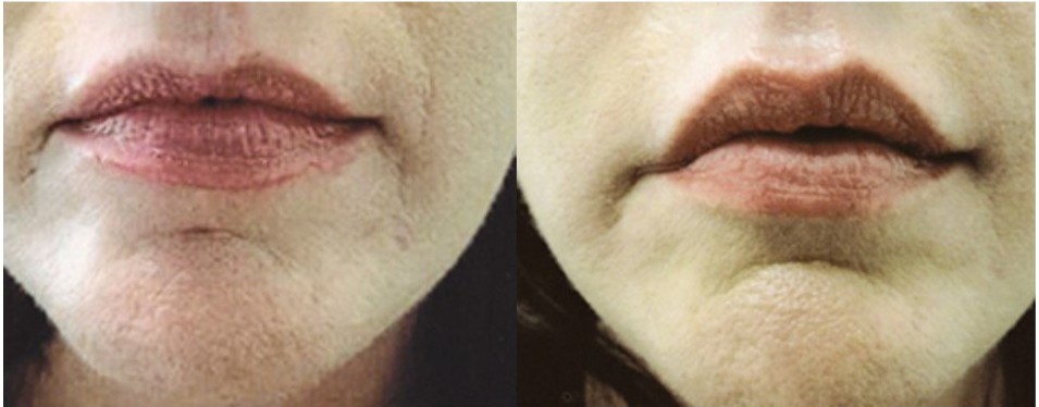 Lip filler by Robert T. Motazedi, MD