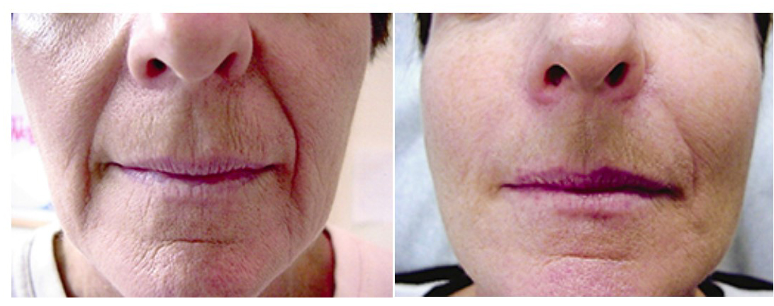 Facial filler before and after