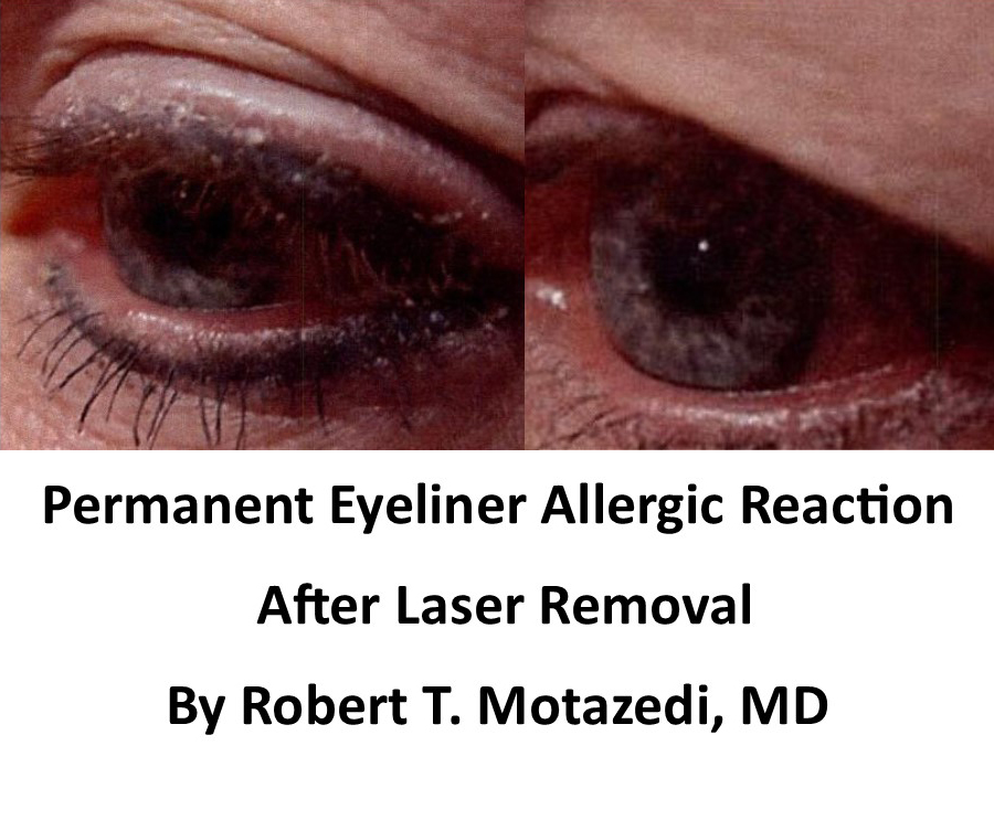 Before And after removal of eyeiner allergy