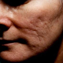 Acne Scars 2