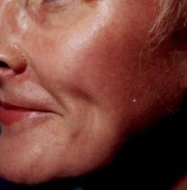 Acne Scars 2a