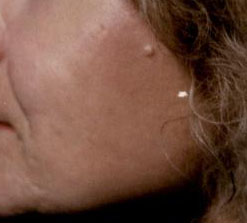 CO2 After cheek Acne Scars