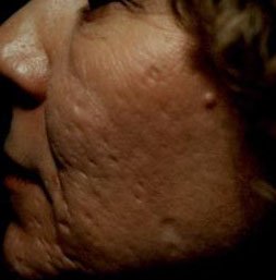 CO2 Before Cheeks Acne Scars